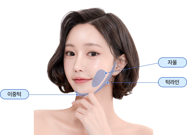 토탈V윤곽술 시술 부위 이미지