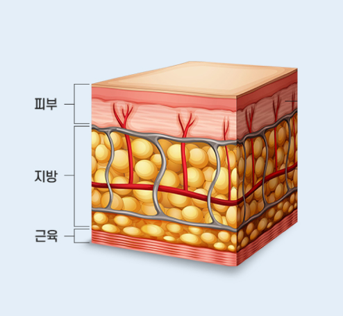 토탈V윤곽술 모델 이미지