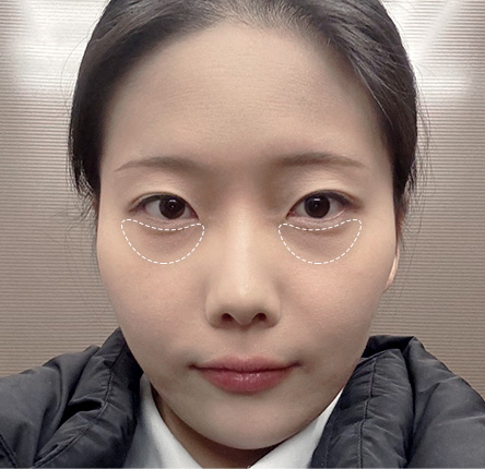 수술 전