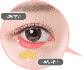 멍, 부기 최소화 해주는 눈 안쪽 결막 수술
