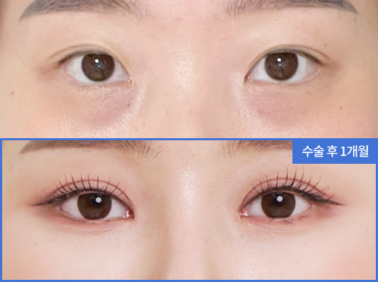 실제 리엔장 수술 환자