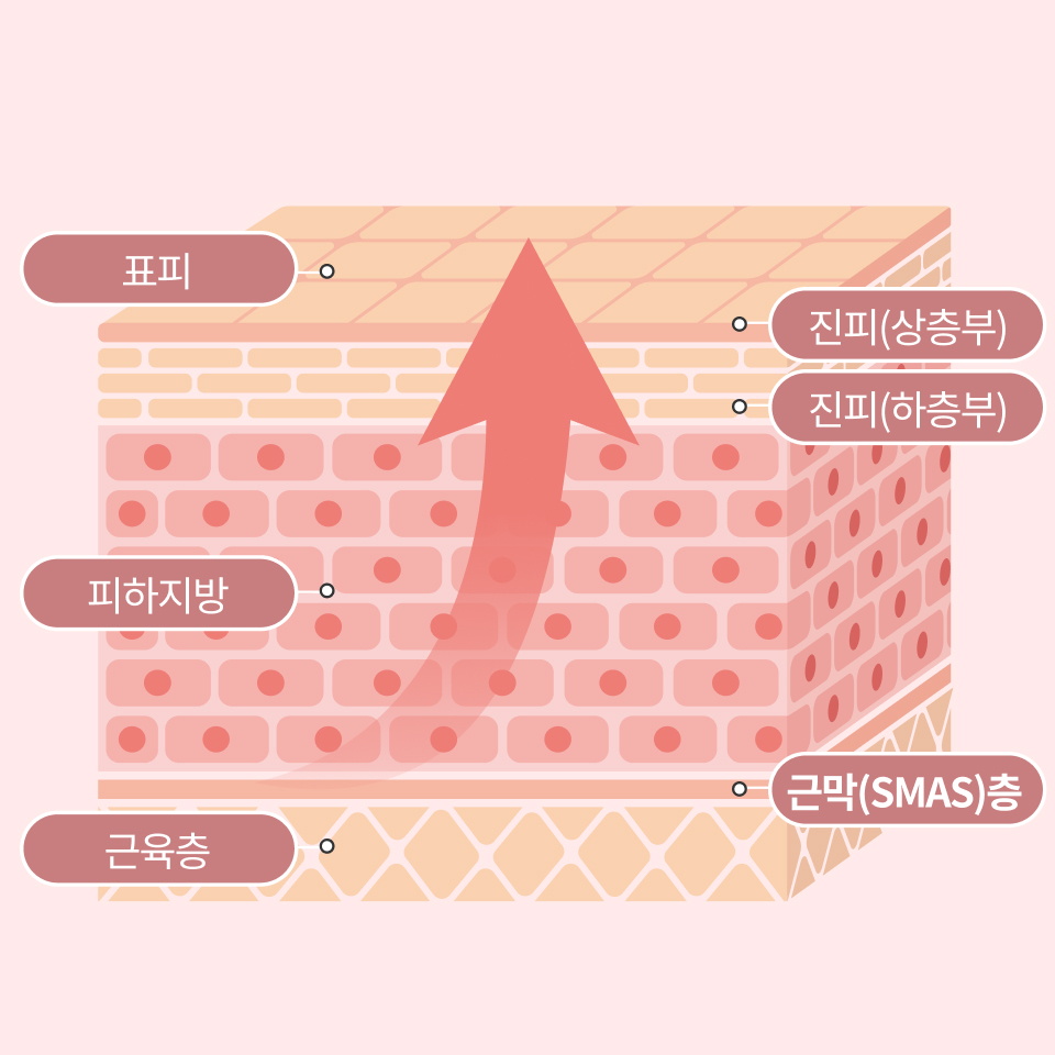 근막층(SMAS)까지 빈틈없이 주름개선