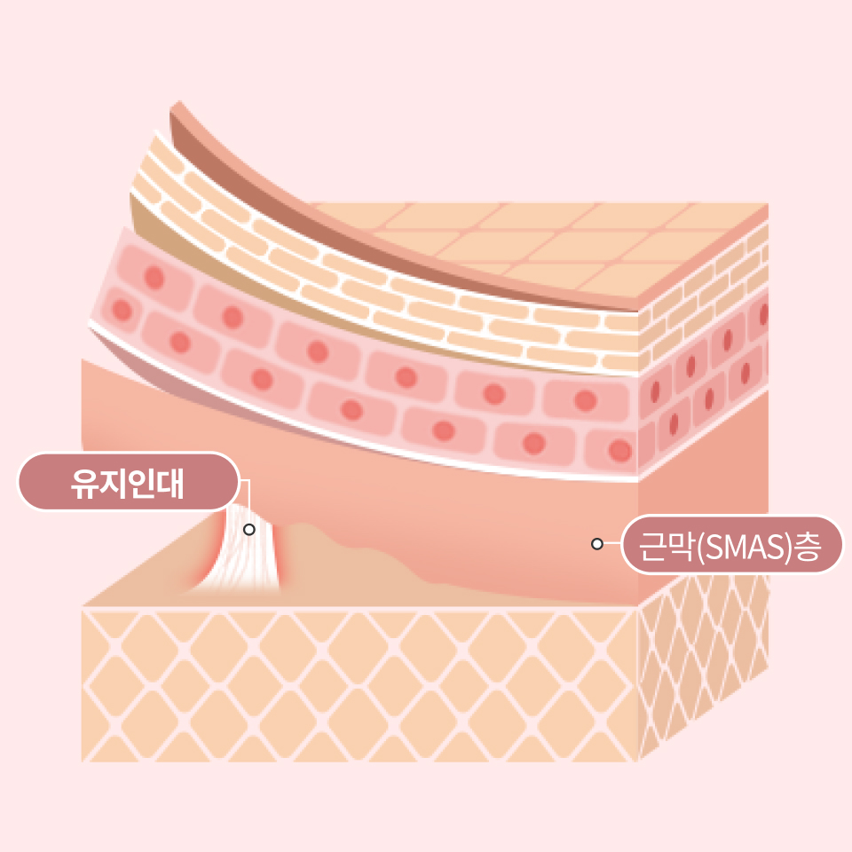 유지인대 박리로 오래가는 유지기간