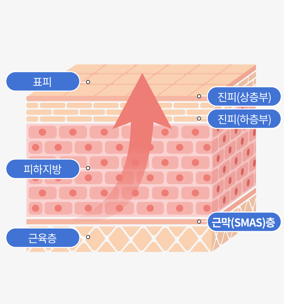 미니턱선리프팅 포인트 2