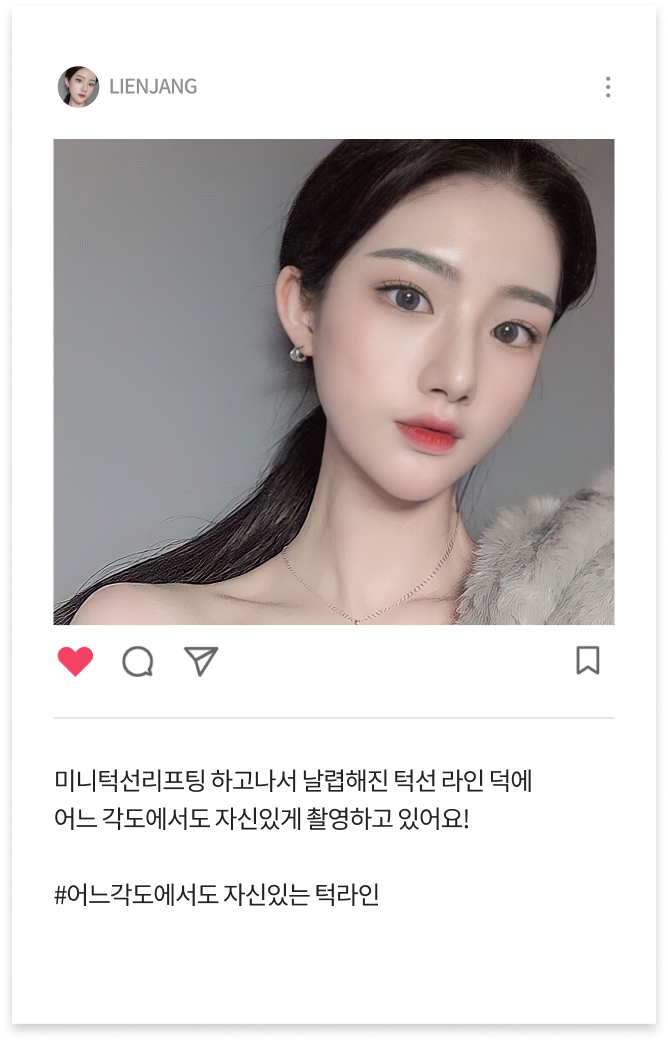 미니턱선리프팅 수술 후 이미지