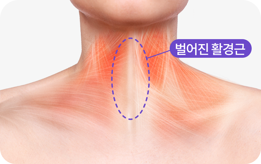 늘어진 목선 활경근 교정 목 주름의 진짜 원인, 활경근부터 바로잡아 매끈한 목을 만듭니다