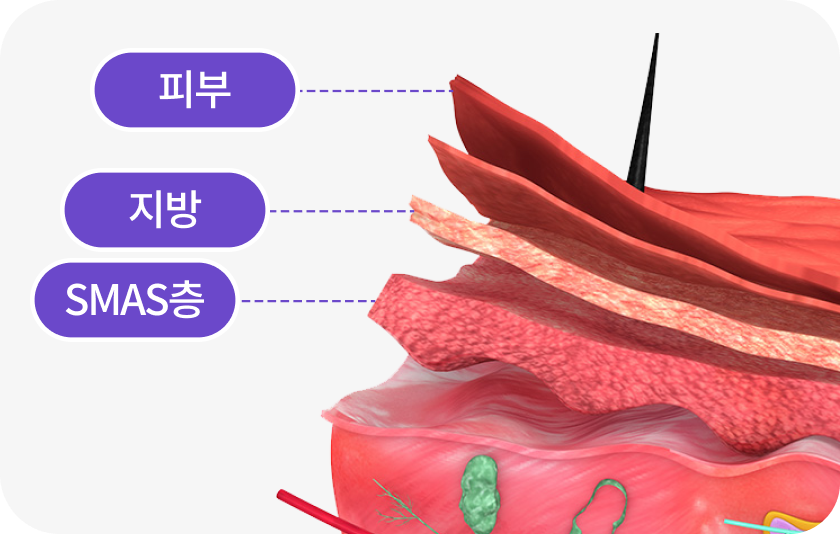 SMAS층 동안 효과의 비결 피부 속 중요한 지지층을 리프팅하여 탄력과 젊음을 되찾습니다