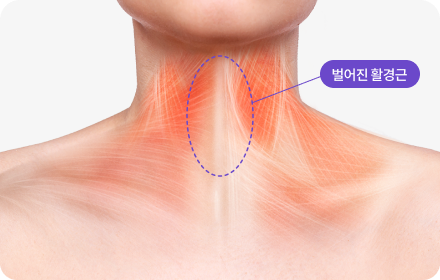 늘어진 목선 활경근 교정 목 주름의 진짜 원인, 활경근부터 바로잡아 매끈한 목을 만듭니다