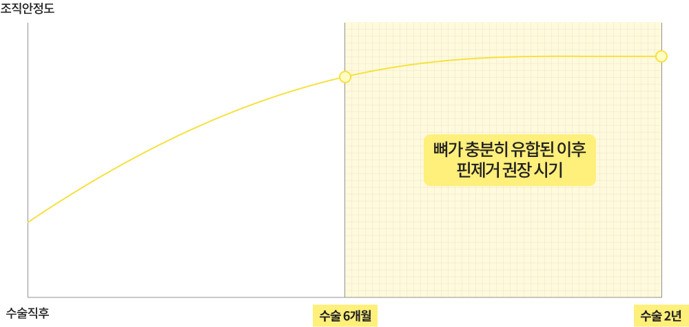 핀제거수술 최적의 타이밍 이미지