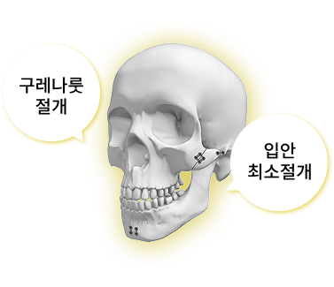 핀제거수술 안전하고 섬세한 핀 제거 수술법 이미지 1